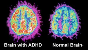 Differences In Brain Structure For Children With ADHD