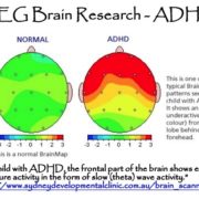 Differences In Brain Structure For Children With ADHD