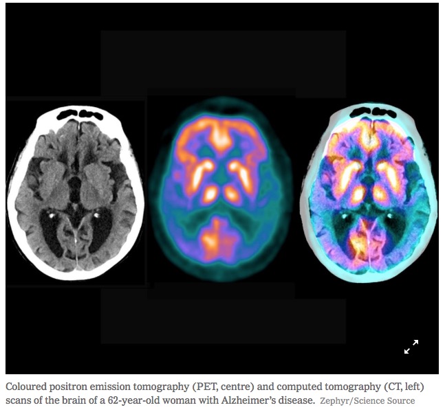 Hypertension & Dementia